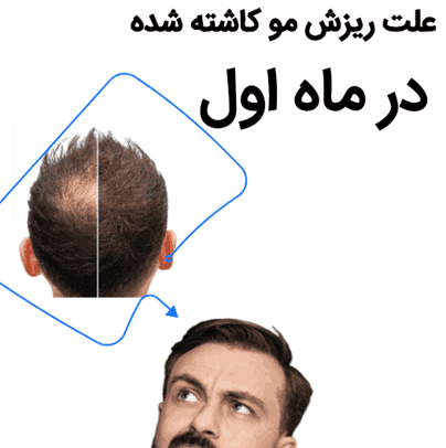علت ریزش موهای کاشته‌شده در ماه اول چیست؟  + دستورالعمل
